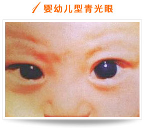 嬰幼兒型青光眼